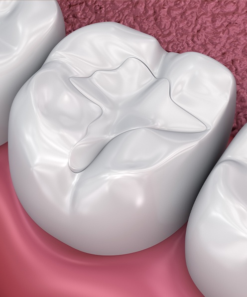 Animated smile after tooth colored filling placement