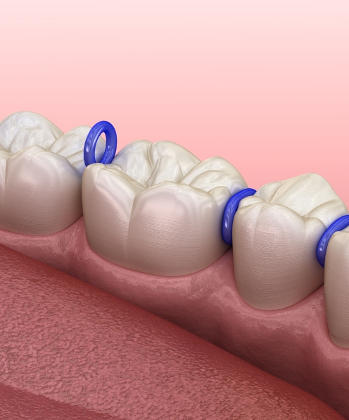 Animated smile with space maintainers in place