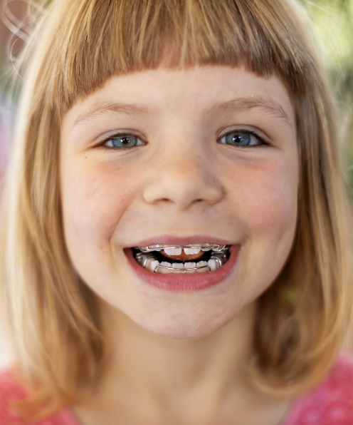 Child with space maintainers smiling