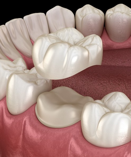 Digital illustration of a children’s dental crown in Buffalo Grove