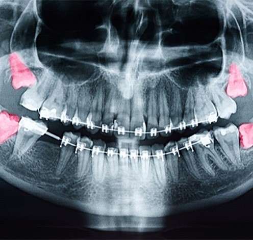 X-ray with wisdom teeth