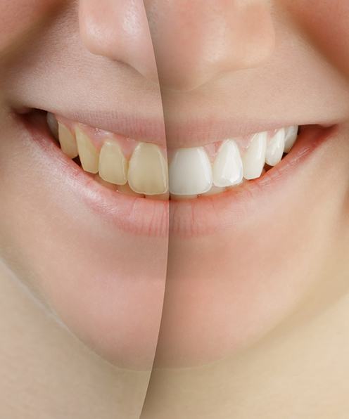 Before and after image of teeth whitening in Buffalo Grove